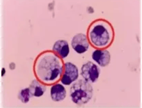 突然确诊<strong></p>
<p>投资理财有限公司</strong>!90后女子傻眼:不痛也不痒……很多人发现就是晚期