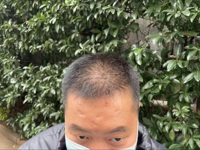“还能反光<strong></p>
<p>多盈理财</strong>！”长沙男子植发近9月称后脑勺“像狗啃过”