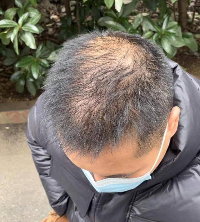“还能反光<strong></p>
<p>多盈理财</strong>！”长沙男子植发近9月称后脑勺“像狗啃过”