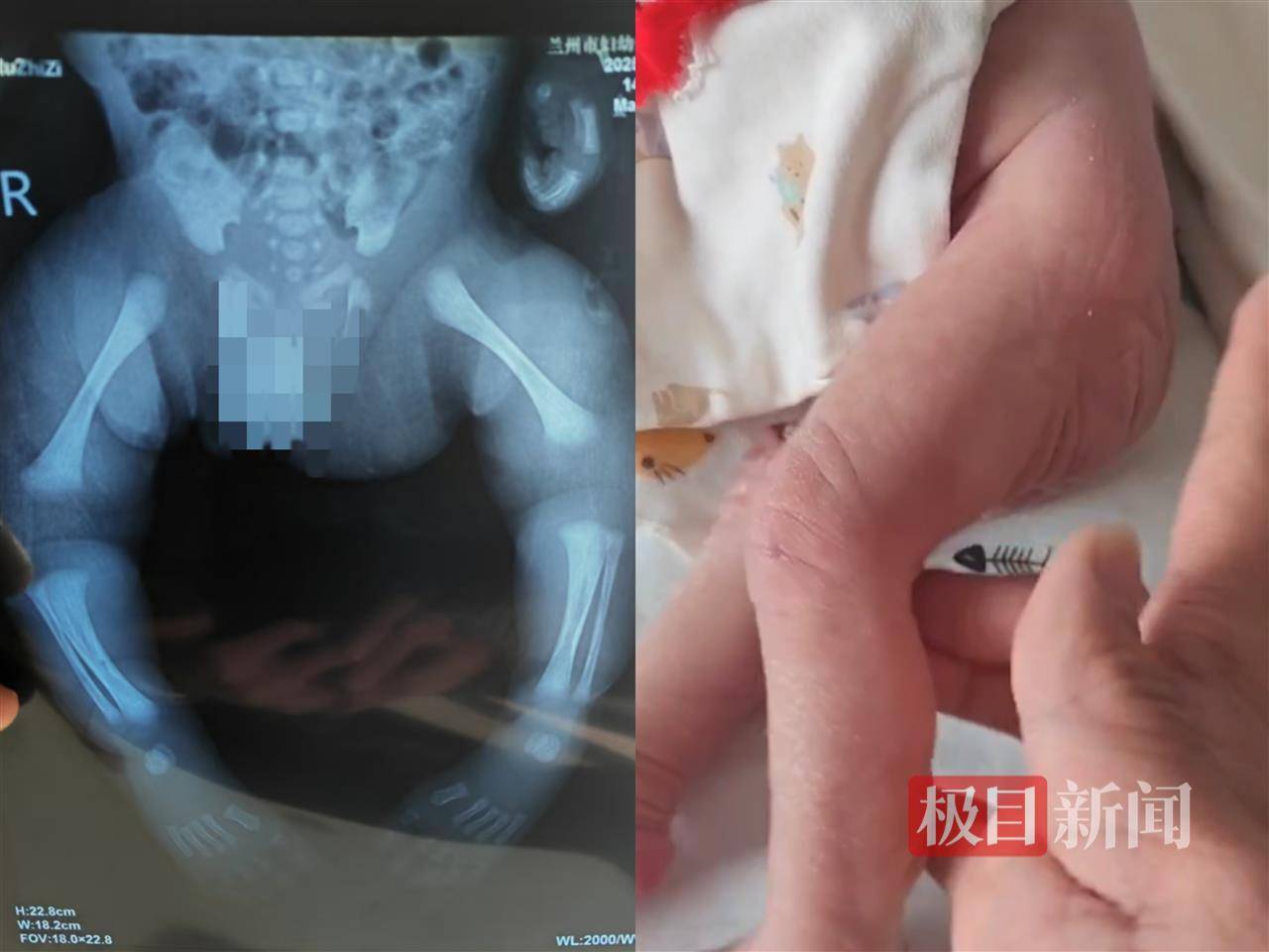二胎出生查出先天性病症或落下残疾<strong></p>
<p>米庄理财</strong>，残疾父母称医院产检漏检、未尽告知义务，医院及医调委回应