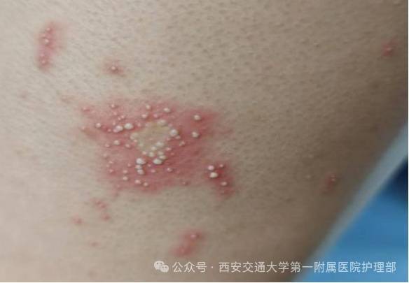 西安多区发现隐翅虫？千万别拍<strong></p>
<p>虚拟币TLS-1</strong>！毒液堪比硫酸