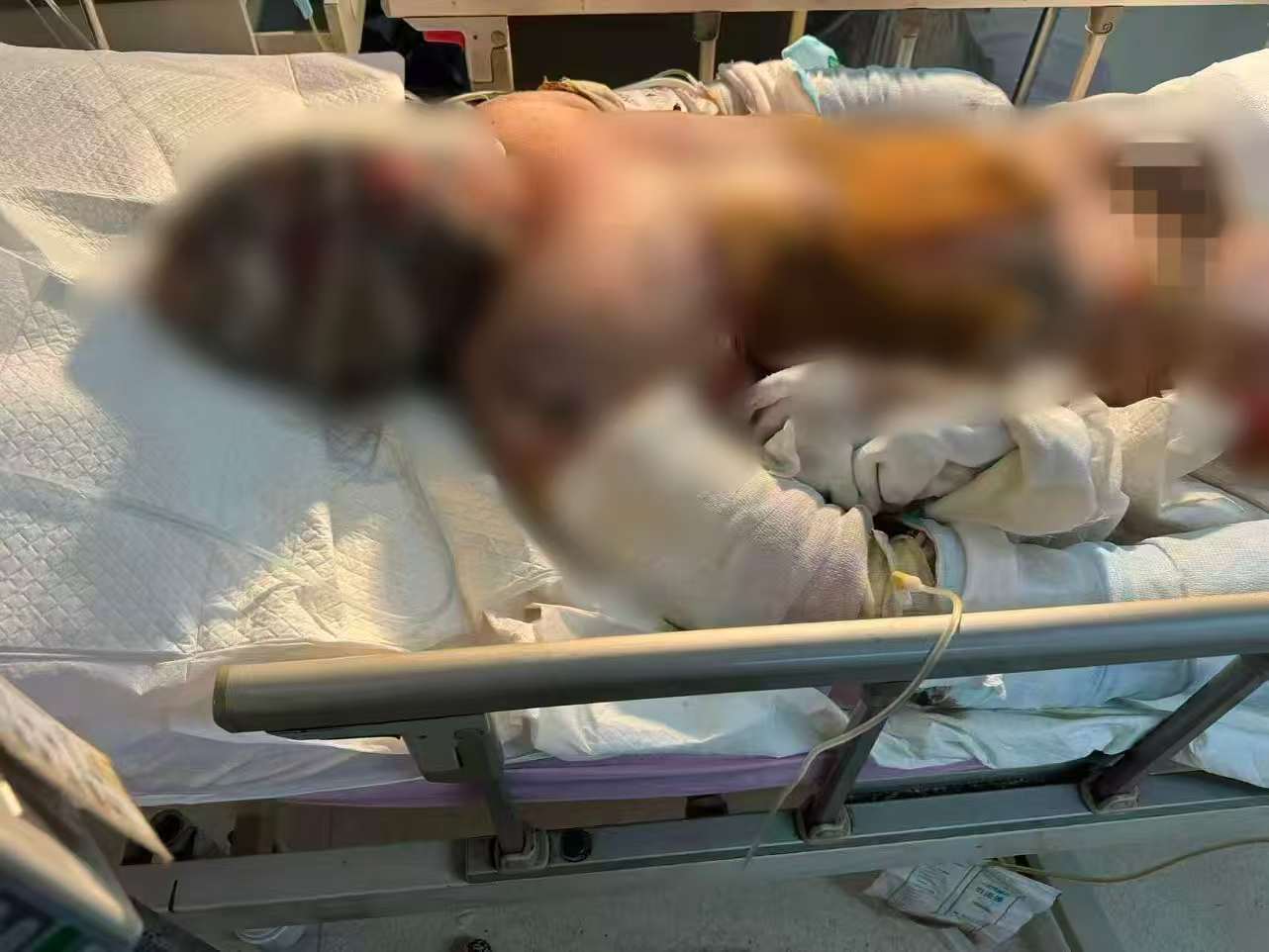 父子在哈尔滨一亲戚公司上班遇爆炸全身烧伤<strong></p>
<p>虚拟币EDU最新消息</strong>，治疗花费近百万公司拒赔偿？亲戚回应