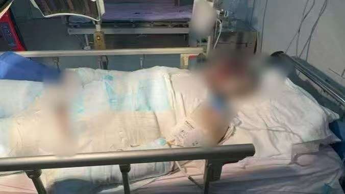 父子在哈尔滨一亲戚公司上班遇爆炸全身烧伤<strong></p>
<p>虚拟币EDU最新消息</strong>，治疗花费近百万公司拒赔偿？亲戚回应