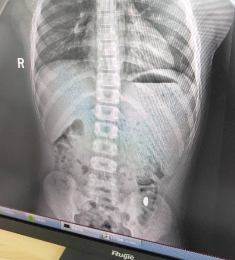 “熊孩子”误吞10克重金豆<strong></p>
<p>防范虚拟币炒作风险</strong>，妈妈：天天叮嘱他不要在外面拉屎