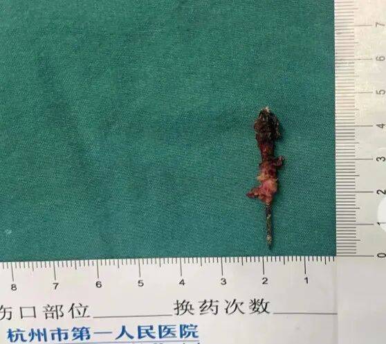 17岁小伙参军体检发现胸腔内有根5cm缝衣针<strong></p>
<p>虚拟币ACN是什么</strong>，父母回忆或是1岁时扎入，取出时已锈迹斑斑